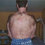 Behandlungsbeginn Epilation Rücken